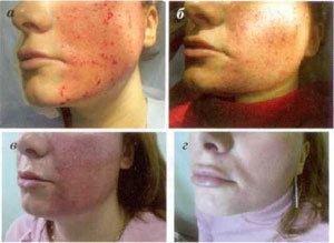 stages of skin restoration after fractional ablation procedures