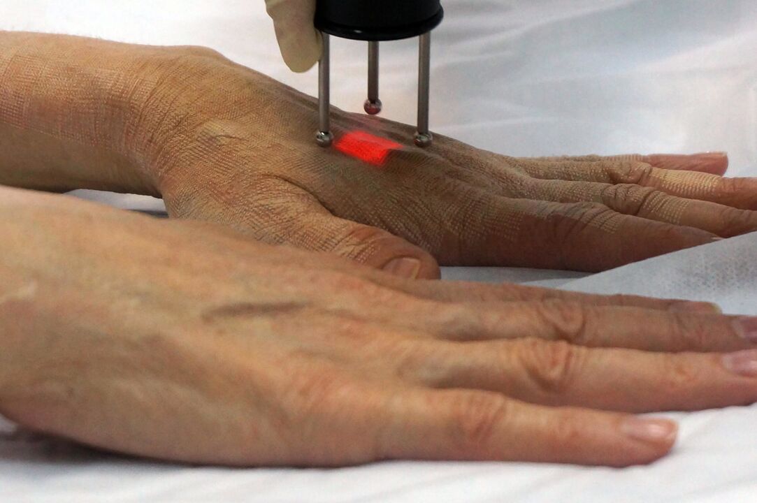 Laser rejuvenation of hands with non-ablative method