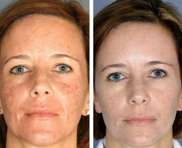 Laser renewal