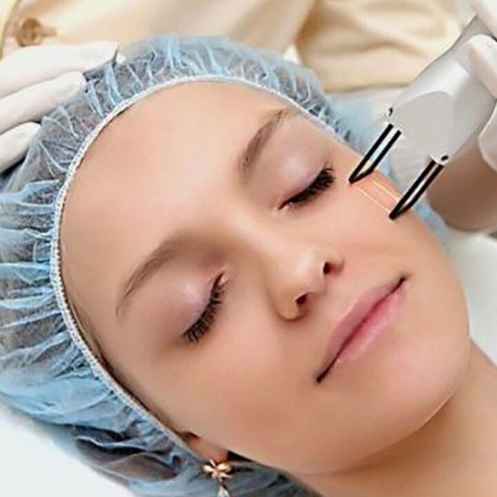 Laser fractional renewal